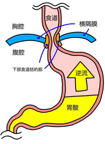 逆流性食道炎のメカニズム